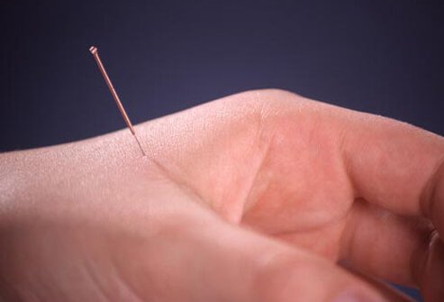 The Role of Acupuncture in Pain Relief